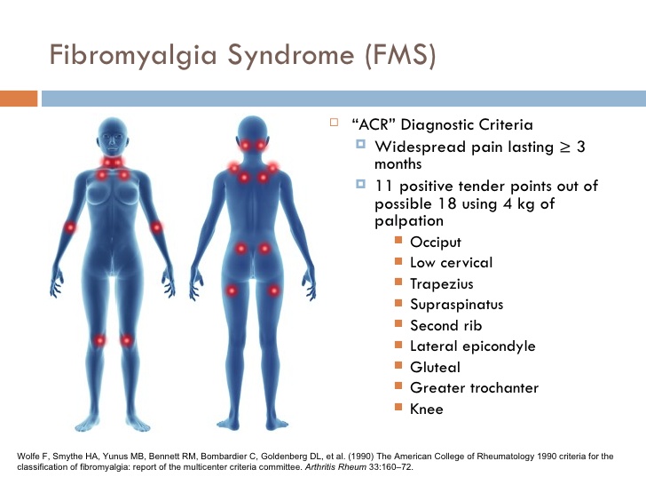 Fibromyalgia Syndrome .jpg